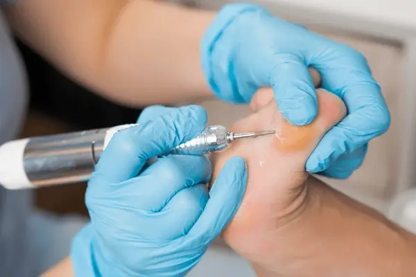 callus care