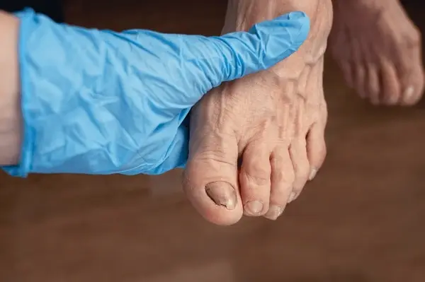 fungal nail treatment near you