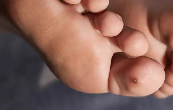 wart removal